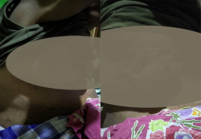 Rosmaladewi Pengidap Kanker Payudara Terkendala Biaya