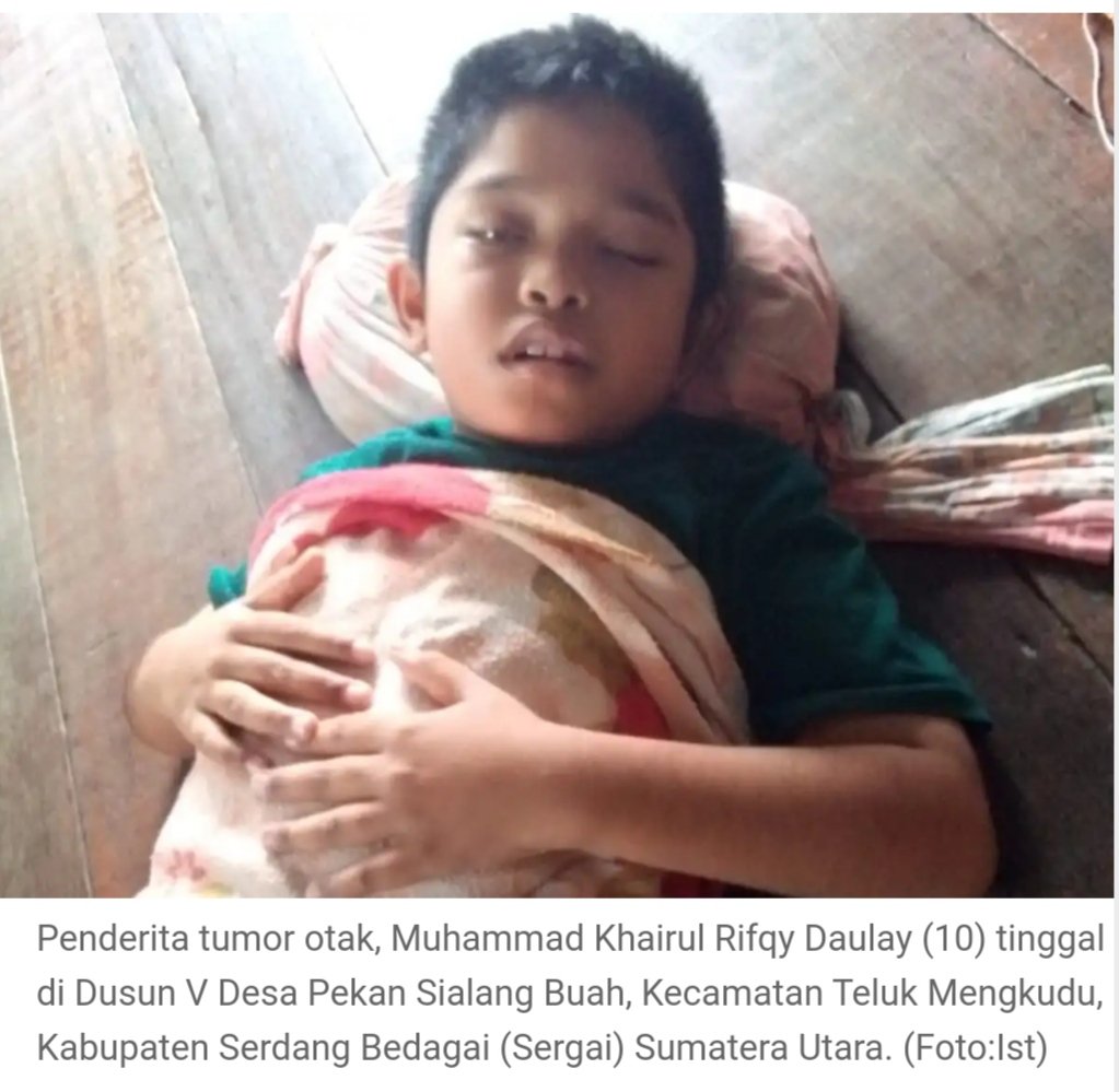 Derita Tumor Otak, Anak di Sergai Butuh Uluran Tangan