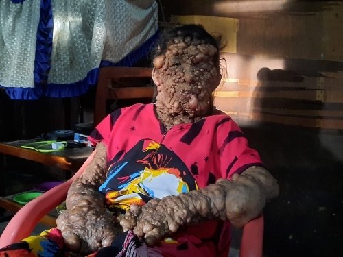 Idap Penyakit Langka Ditumbuhi Benjolan, Warga Paluta Ini Butuh Bantuan