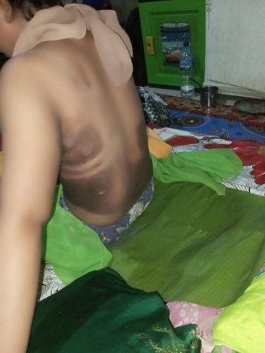 Terbakar Api Cemburu, Oknum Sekdes di Kota Sidimpuan Diduga Bakar Kekasihnya